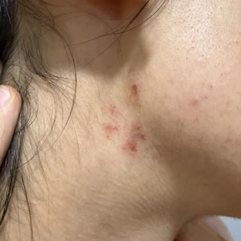 Lazer Epilasyon Sonrası Cilt Yanıkları