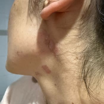 Lazer Epilasyon Sonrası Cilt Yanıkları