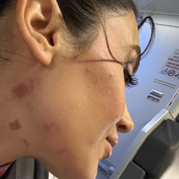 Lazer Epilasyon Sonrası Cilt Yanıkları