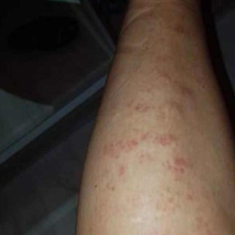 Güzellik Merkezinde Yanık Ve Tehdit