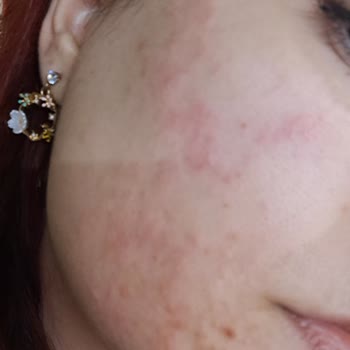 Dermapen İşleminde Zorunlu Ürün Satışı Ve Gizli Sözleşme Maddeleri