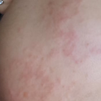 Dermapen İşleminde Zorunlu Ürün Satışı Ve Gizli Sözleşme Maddeleri