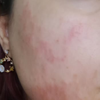 Dermapen İşleminde Zorunlu Ürün Satışı Ve Gizli Sözleşme Maddeleri