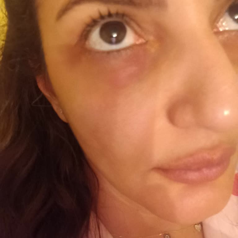 Estee Lauder Ürünleri Beklenmedik Cilt Sorunlarına Yol Açtı