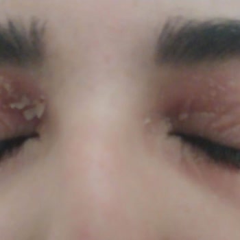 Gratis'ten Alınan Rimel Sonrası Cilt Sorunu