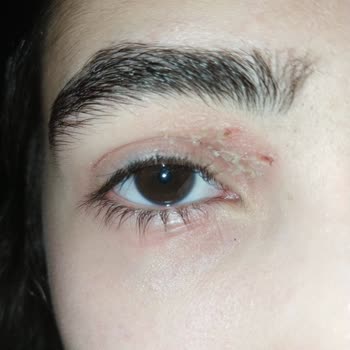 Gratis'ten Alınan Rimel Sonrası Cilt Sorunu