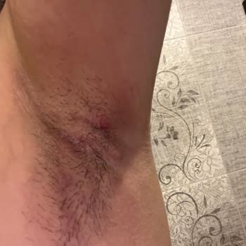 Dove Deodorant Kullanımı Sonrası Ciddi Sağlık Sorunları