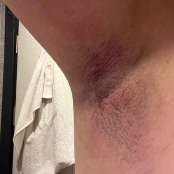 Dove Deodorant Kullanımı Sonrası Ciddi Sağlık Sorunları