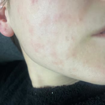 Bioderma Ürünleri Hassas Ciltlerde Sorun Yarattı