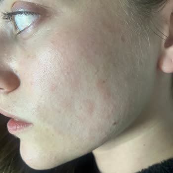 Bioderma Ürünleri Hassas Ciltlerde Sorun Yarattı