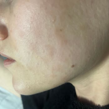 Bioderma Ürünleri Hassas Ciltlerde Sorun Yarattı