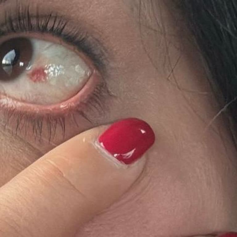 Now Yaşam Sağlık Kirpik Lifting Sonrası Göz Tahrişi!