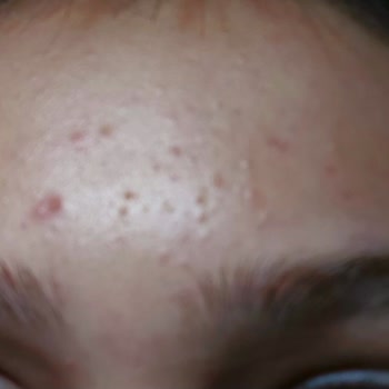 Cilt Sorunlarına Yol Açan CC Krem