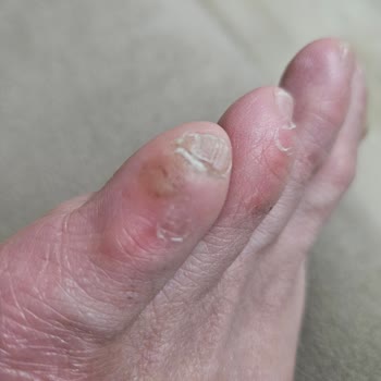 Ayakkabı Rahatsızlığına Çözüm Bulunamıyor