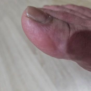 Ayakkabı Rahatsızlığına Çözüm Bulunamıyor