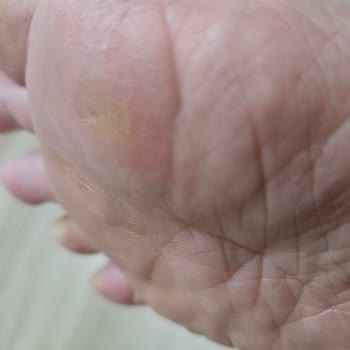 Ayakkabı Rahatsızlığına Çözüm Bulunamıyor