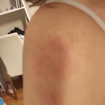 Epilasyon Seansında Yaşanan Mağduriyet Ve İade Sorunu