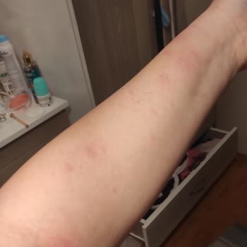 Epilasyon Seansında Yaşanan Mağduriyet Ve İade Sorunu