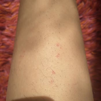 Tüy Dökücü Krem Cildimi Tahriş Etti