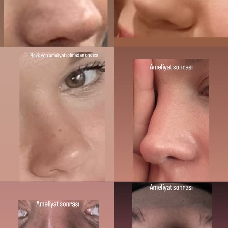 Mclinic - Doç. Dr. Mustafa Çelik Revizyon Ameliyatı Sonrası Hayal Kırıklığı!