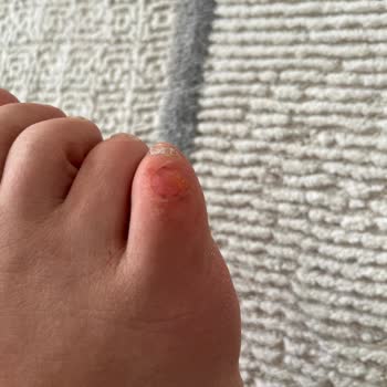 Skechers Ayakkabıları Ayaklarımı Yaraladı!