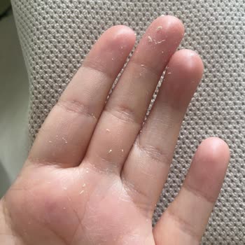 Uriage Güneş Kremi Cildimde Plastik Gibi Soyuluyor