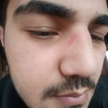 Atasun Optik'ten Aldığım Gözlük Burnumu Yaraladı