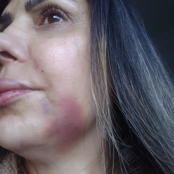 Estetik Merkezinde Kötü Deneyim Ve İade Sorunu