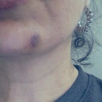 Estetik Merkezinde Kötü Deneyim Ve İade Sorunu