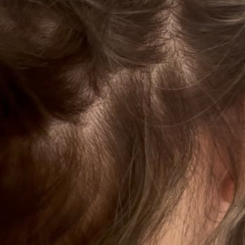 Saç Boyama Sonrası Hayal Kırıklığı Ve Maddi Zarar