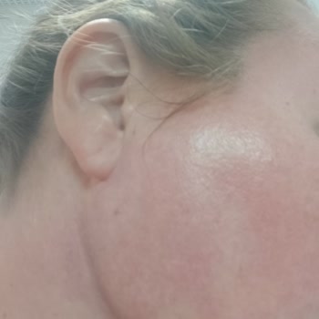 Eyüp Sabri Tuncer Gül Suyu Cilt Reaksiyonlarına Sebep Oldu