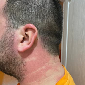 Alerjik Reaksiyon: Doğal Ürün Hayal Kırıklığı