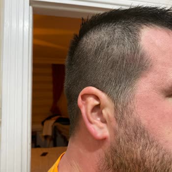 Alerjik Reaksiyon: Doğal Ürün Hayal Kırıklığı