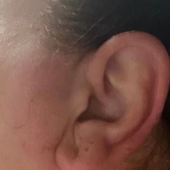 JBL Kulaklık Alerji Ve Egzama Sorunu