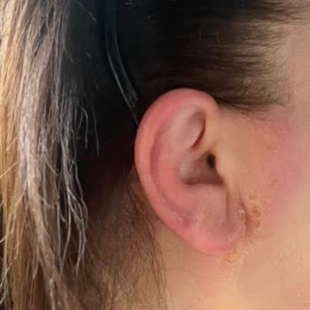 JBL Kulaklık Alerji Ve Egzama Sorunu