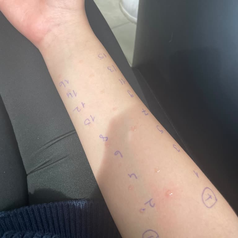 Hastanede Alerji Testi Karmaşası Ve Yanıltıcı Sonuçlar