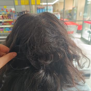 Elidor Şampuan Kullanımı Sonrası Saç Dökülmesi