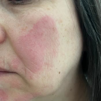 Alerjik Reaksiyon: Yves Rocher Yüz Temizleme Jeli