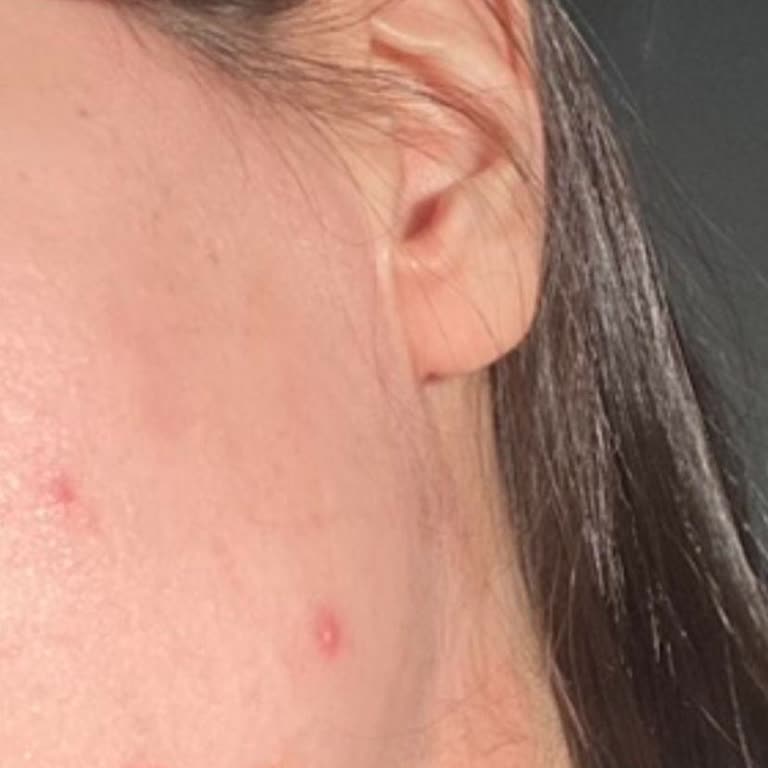 La Roche - Posay Cilt Bakım Ürünü Değişikliği Cildimi Mahvetti