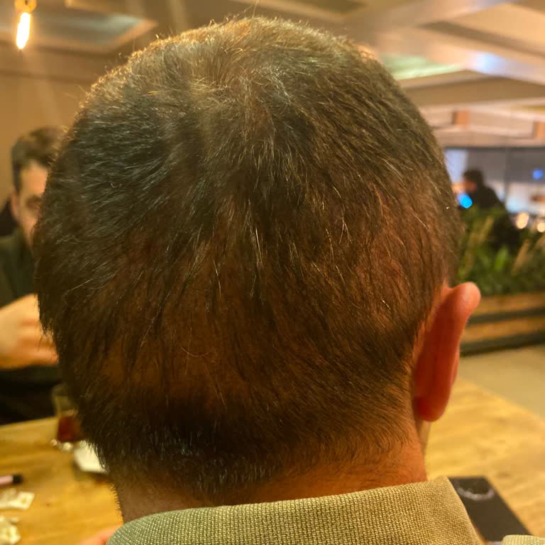 Sankolis Saçlarımı Mahvettiler