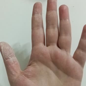 Vanish Kosla İle Cilt Yanığı Tehlikesi