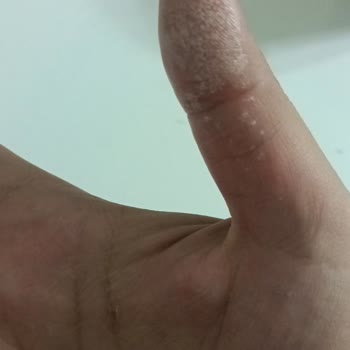 Vanish Kosla İle Cilt Yanığı Tehlikesi