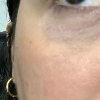 Yves Rocher Göz Altı Kremi Alerjik Reaksiyon Yarattı!