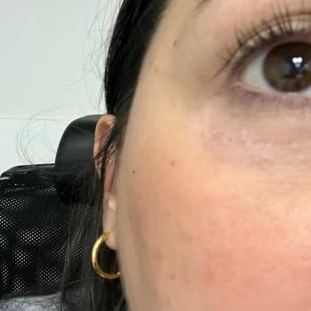 Yves Rocher Göz Altı Kremi Alerjik Reaksiyon Yarattı!