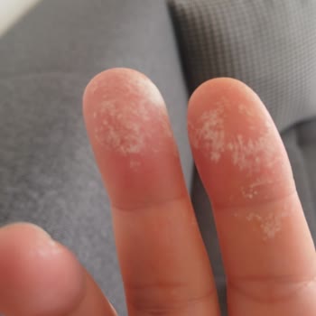 Leke Çıkarıcı Yan Etkileriyle Hayal Kırıklığı Yaratıyor