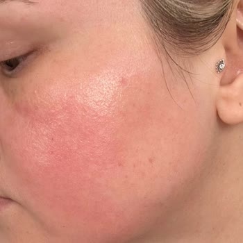 Ciltte Beklenmedik Reaksiyon