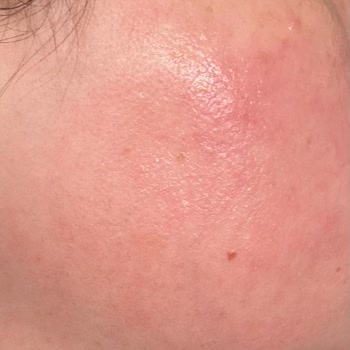 Ciltte Beklenmedik Reaksiyon