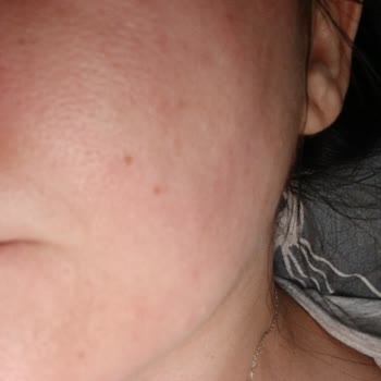 Ciltte Beklenmedik Reaksiyon