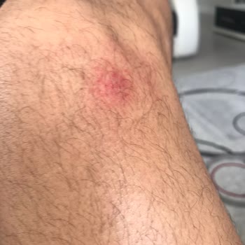 Navee N65 Scooter Fren Arızasıyla Yaşanan Tehlikeli Kaza