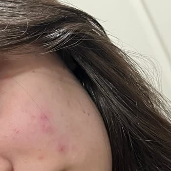 Loreal Paris Fondöteni Cilt Sorunlarına Yol Açtı